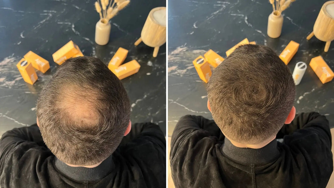 Comment masquer une calvitie naissante ? Nos solutions efficaces !